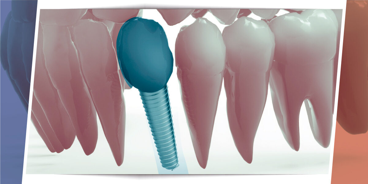 implante-dental-ameridental
